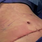 Liposuction