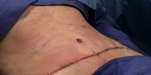 Liposuction mark