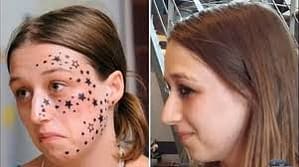 laser tattoo removal on face