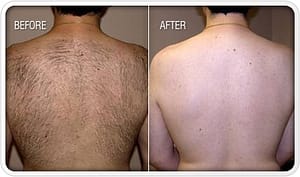 back hair removal result