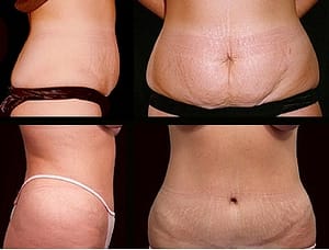 Liposuction result